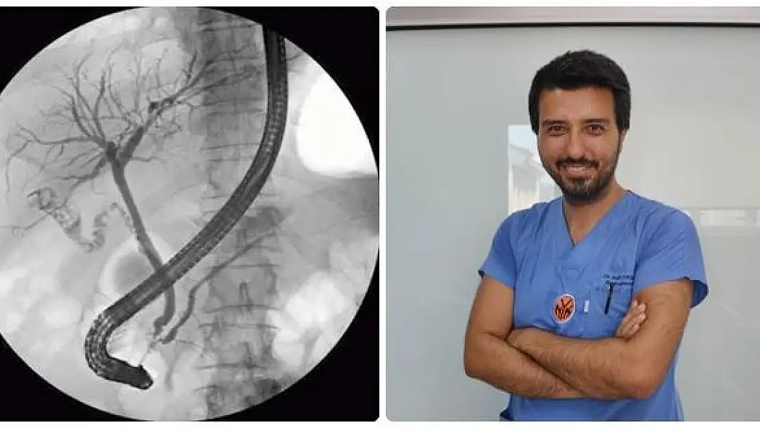 Devlet Hastanesinde ERCP işlemi yapılıyor