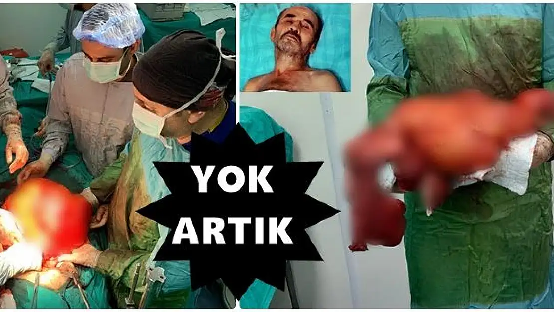 Karnında 1 yaşında çocuk büyüklüğünde kitle taşımış
