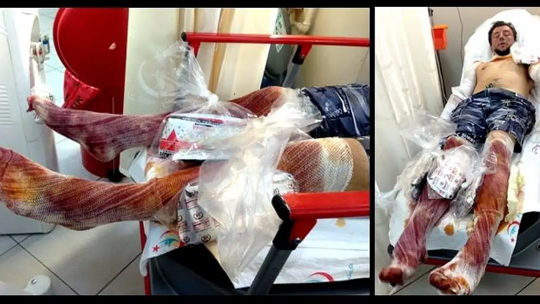 Teknede patlama, 1 yaralı
