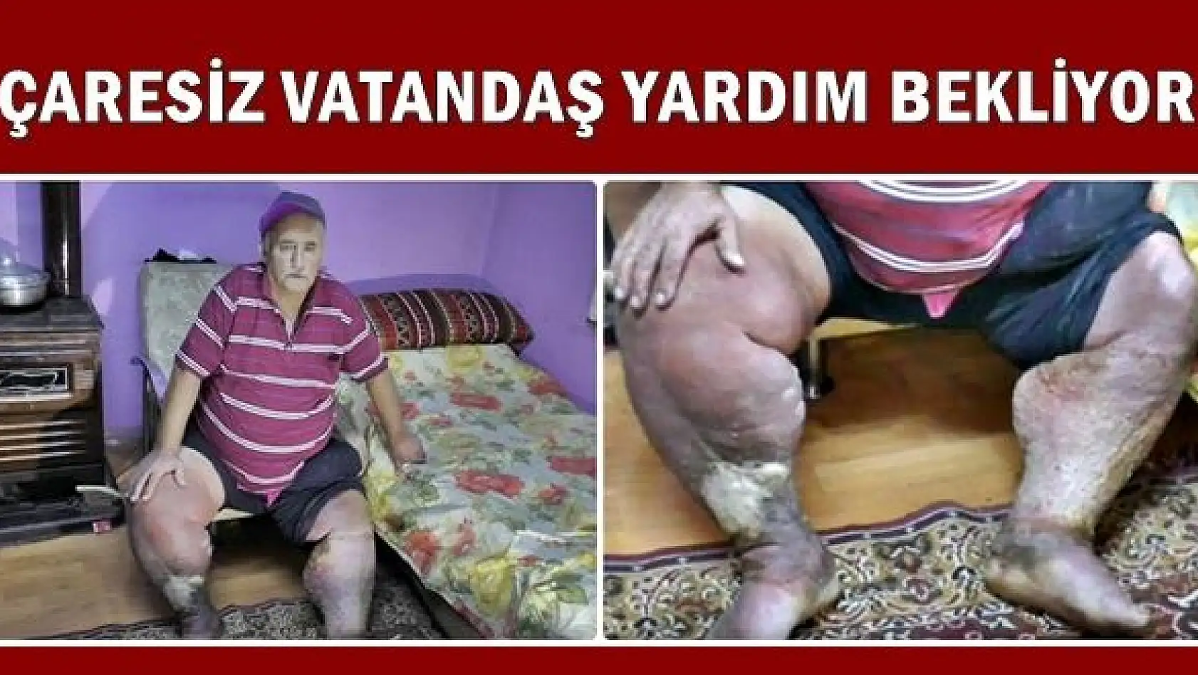 Fil hastalığına yakalan vatandaş yardım bekliyor